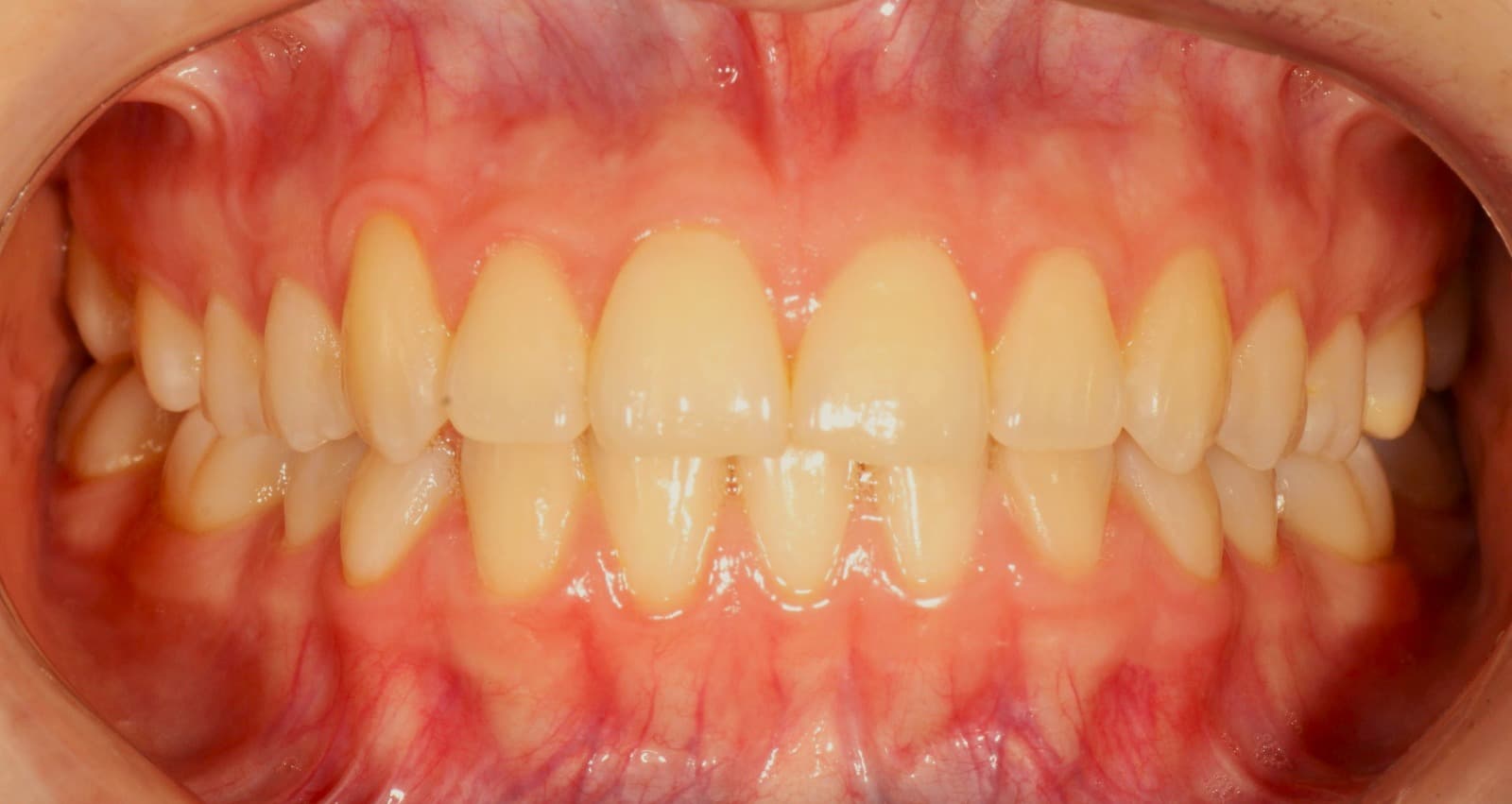DISEÑO DE SONRISA(SMILE DESIGN)
