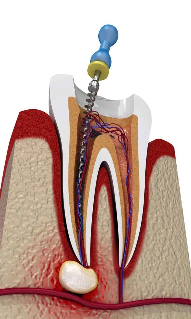 ENDODONCIA (TRATAMIENTO DE CANALES)