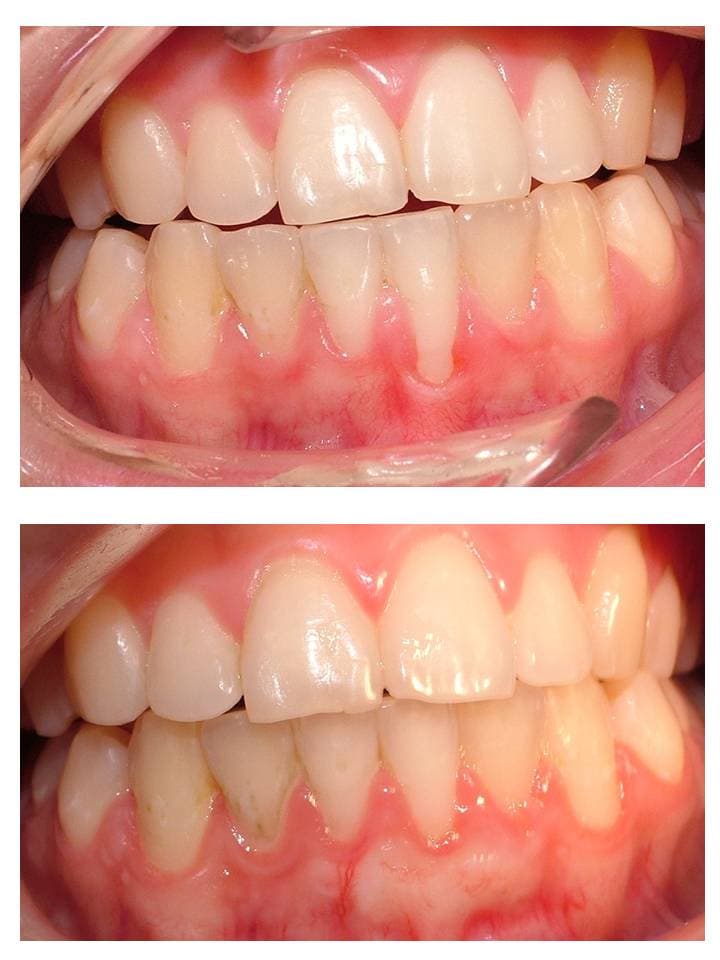 PERIODONCIA (TRATAMIENTO DE ENCÍAS)